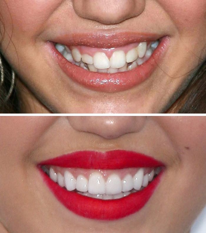 Miley Cyrus teeth comparison